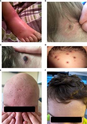 Case report: Cellular therapy for hydroa vacciniforme-like lymphoproliferative disorder in pediatric common variable immunodeficiency with chronic active Epstein-Barr virus infection